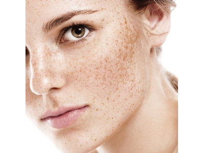 Як запобігти пігментації?