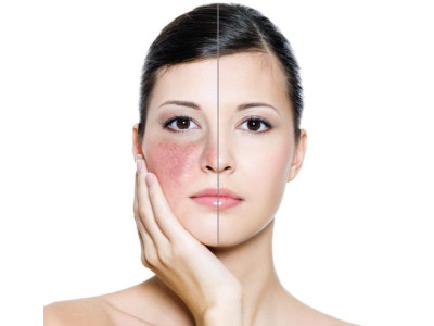 Ефективний догляд за шкірою, схильною до куперозу